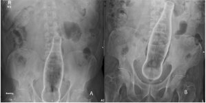 retained-colorectal-foreign-body 1.jpg